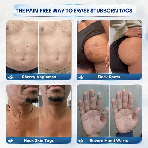 𝑻𝒐𝒑𝑺𝒑𝒊𝒓𝒆® 7-𝐃𝐚𝐲 𝐒𝐤𝐢𝐧 𝐓𝐚𝐠 & 𝐒𝐩𝐨𝐭 𝐄𝐫𝐚𝐬𝐞𝐫 𝐂𝐫𝐞𝐚𝐦 (Zero Pain, Zero 𝐒𝐜𝐚𝐫𝐬 Formula) 🦅