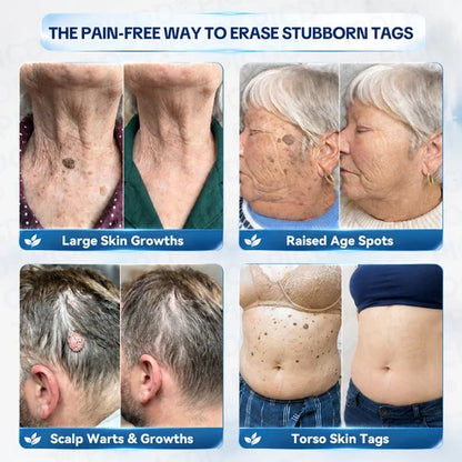 𝑻𝒐𝒑𝑺𝒑𝒊𝒓𝒆® 7-𝐃𝐚𝐲 𝐒𝐤𝐢𝐧 𝐓𝐚𝐠 & 𝐒𝐩𝐨𝐭 𝐄𝐫𝐚𝐬𝐞𝐫 𝐂𝐫𝐞𝐚𝐦 (Zero Pain, Zero 𝐒𝐜𝐚𝐫𝐬 Formula) 🦅