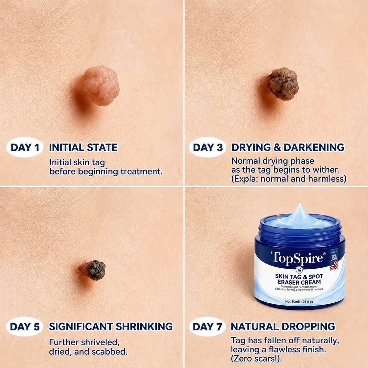 𝑻𝒐𝒑𝑺𝒑𝒊𝒓𝒆® 7-𝐃𝐚𝐲 𝐒𝐤𝐢𝐧 𝐓𝐚𝐠 & 𝐒𝐩𝐨𝐭 𝐄𝐫𝐚𝐬𝐞𝐫 𝐂𝐫𝐞𝐚𝐦 (Zero Pain, Zero 𝐒𝐜𝐚𝐫𝐬 Formula) 🦅