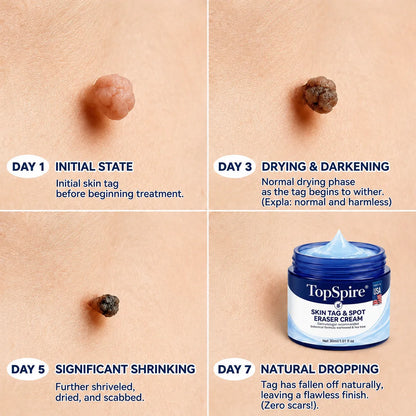 𝑻𝒐𝒑𝑺𝒑𝒊𝒓𝒆® 7-𝐃𝐚𝐲 𝐒𝐤𝐢𝐧 𝐓𝐚𝐠 & 𝐒𝐩𝐨𝐭 𝐄𝐫𝐚𝐬𝐞𝐫 𝐂𝐫𝐞𝐚𝐦 (Zero Pain, Zero 𝐒𝐜𝐚𝐫𝐬 Formula) 🦅